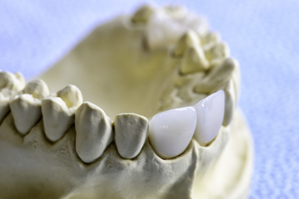 Couronne dentaire dentiste Marlenheim Dr Dominguez Benjamin
