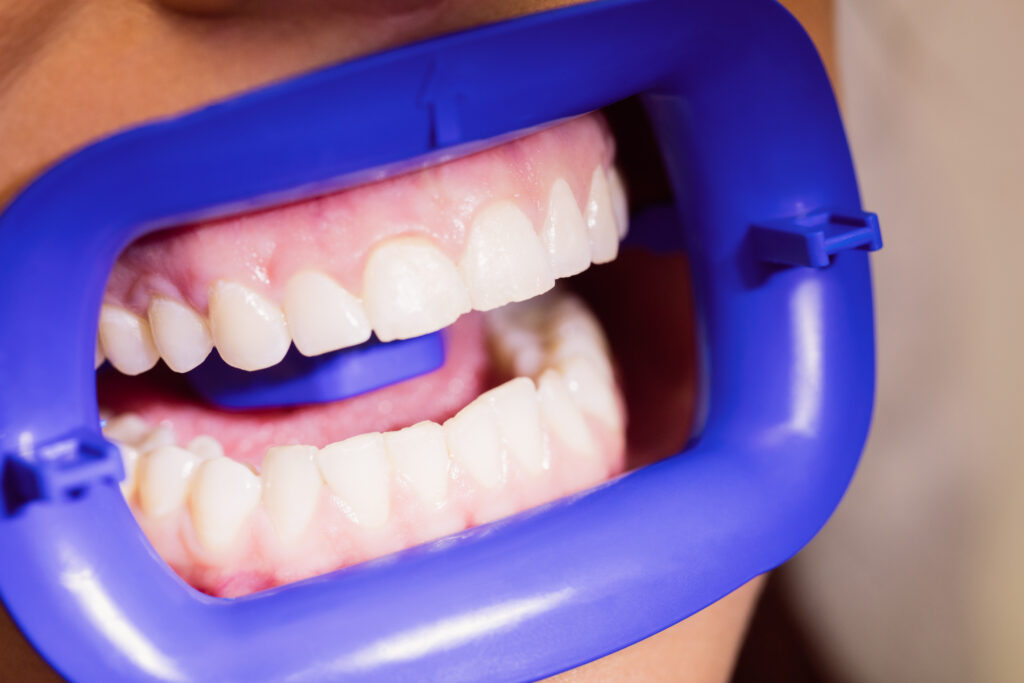 blanchiment dentiste dr dominguez benjamin marlenheim