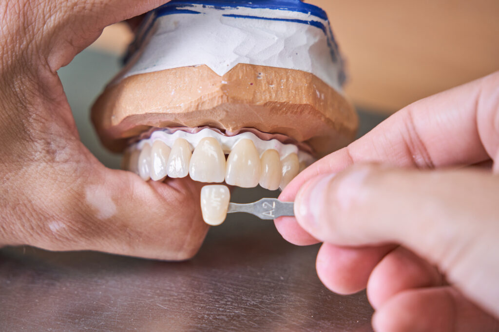 Bridge dentiste Marlenheim Dr Dominguez Benjamin