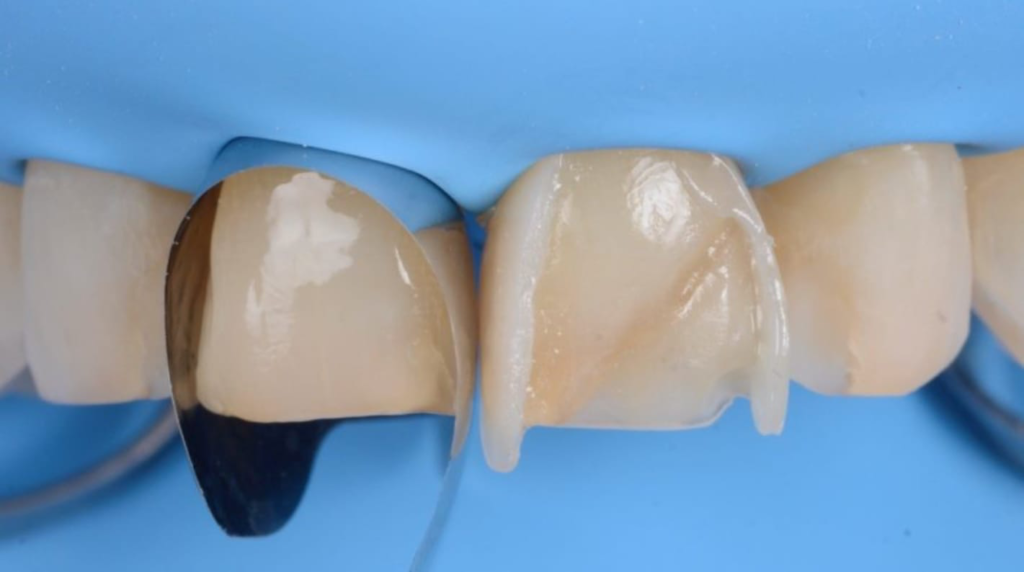 composite antérieur dentiste Dr Dominguez Marlenheim
