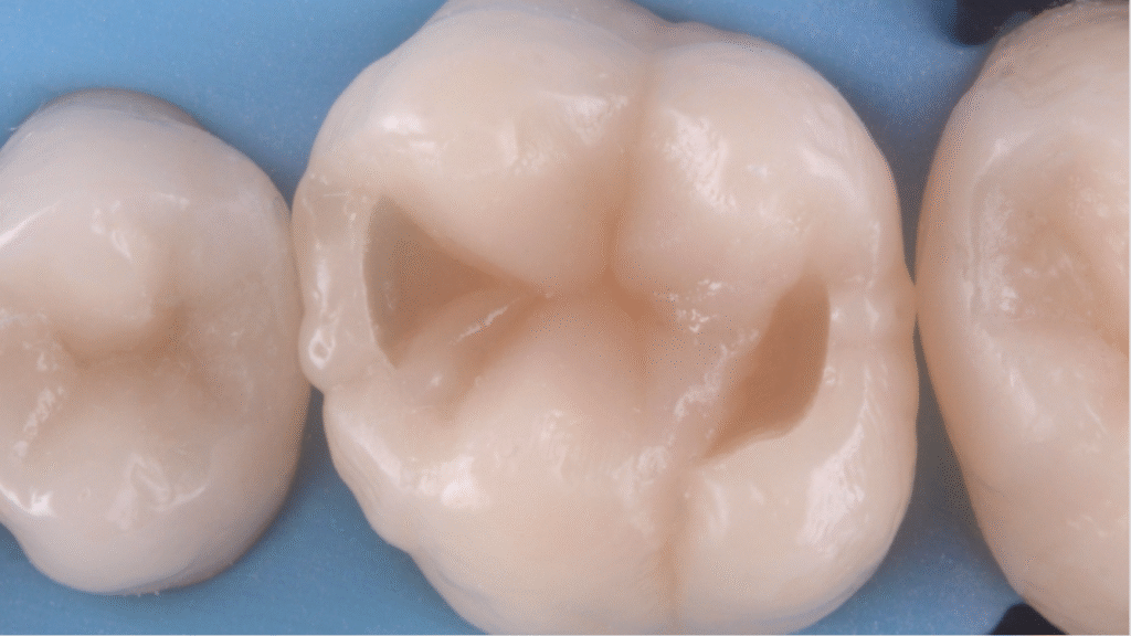 composite dentaire dentiste Dr Dominguez Marlenheim