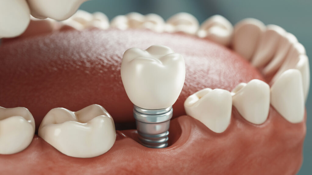 couronne implant dentiste Marlenheim Dr Dominguez Benjamin