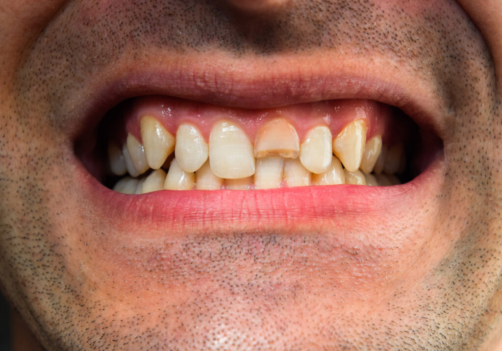 dent cassée dentiste marlenheim dr dominguez benjamin