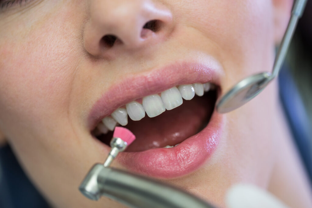 détartrage dentiste dr dominguez benjamin marlenheim