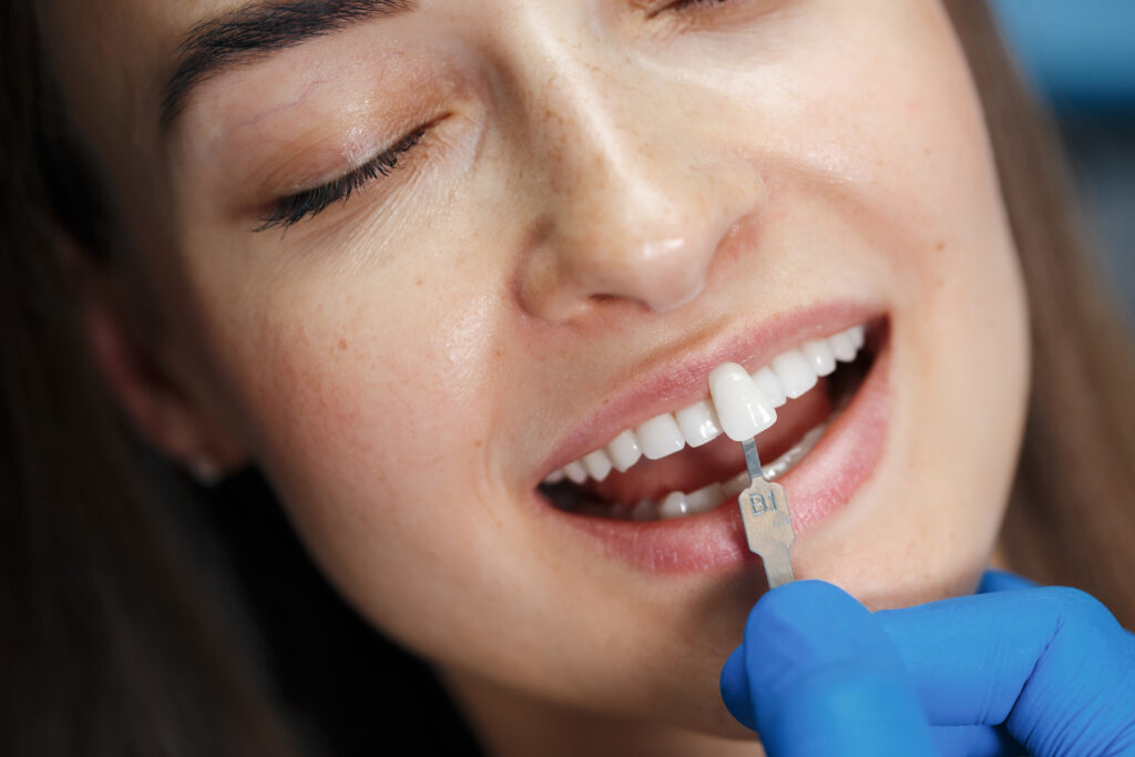 facette dentaire dentiste Marlenheim Dr Dominguez Benjamin