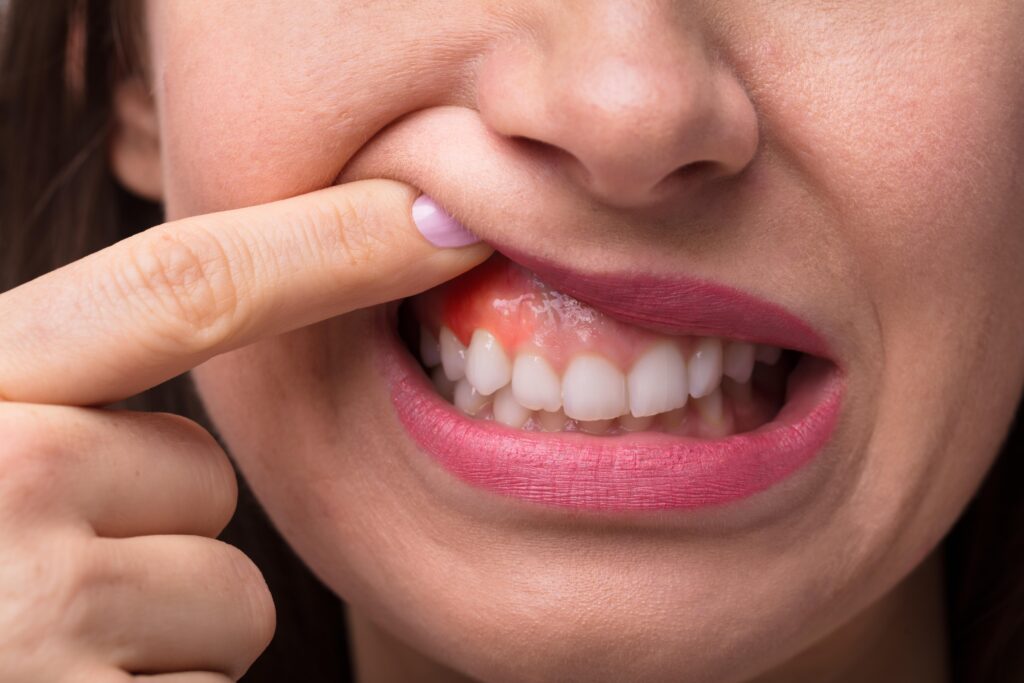 inflammation ginvivale dentiste marlenheim dr dominguez benjamin