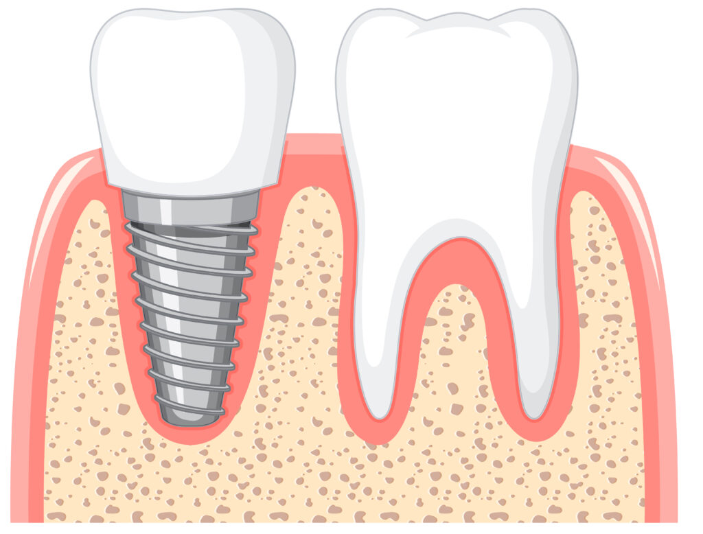 implant dentiste Marlenheim Dr Dominguez Benjamin