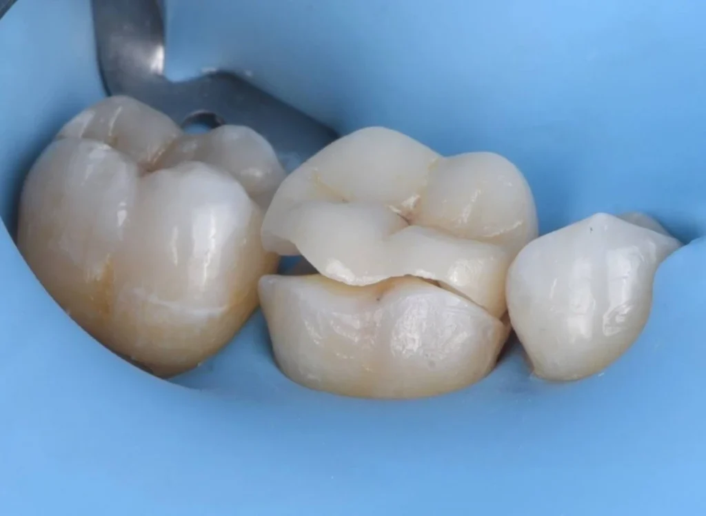 inlay dentiste Marlenheim Dr Dominguez Benjamin