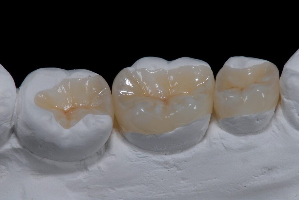 onlays dentiste Marlenheim Dr Dominguez Benjamin